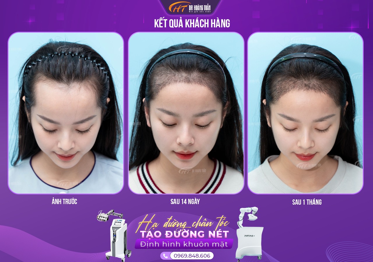 Cấy t&oacute;c FUE v&agrave; FUT