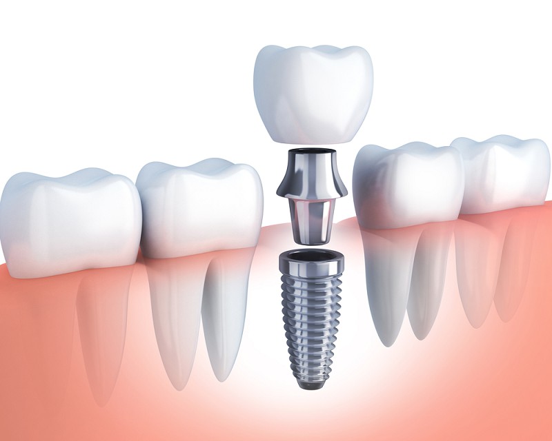 Cấy ghép Implant