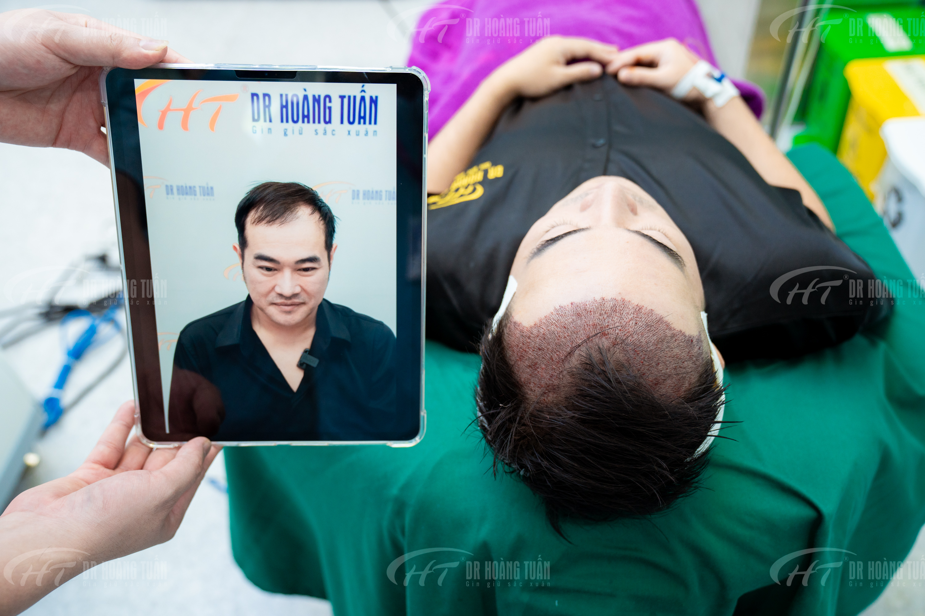 Dịch vụ cấy t&oacute;c tại Dr Ho&agrave;ng Tuấn