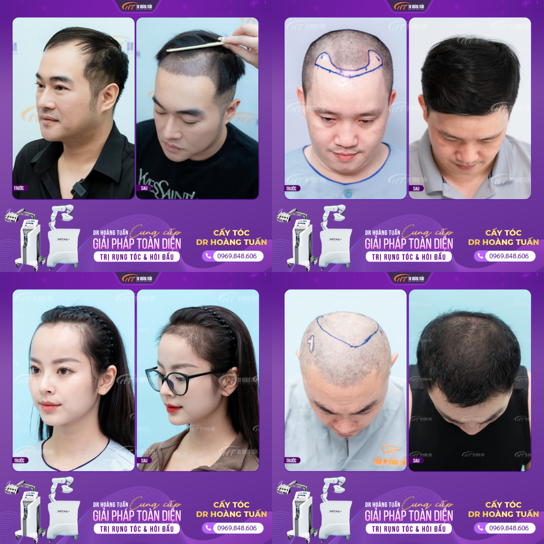 chi ph&iacute; cấy  t&oacute;c