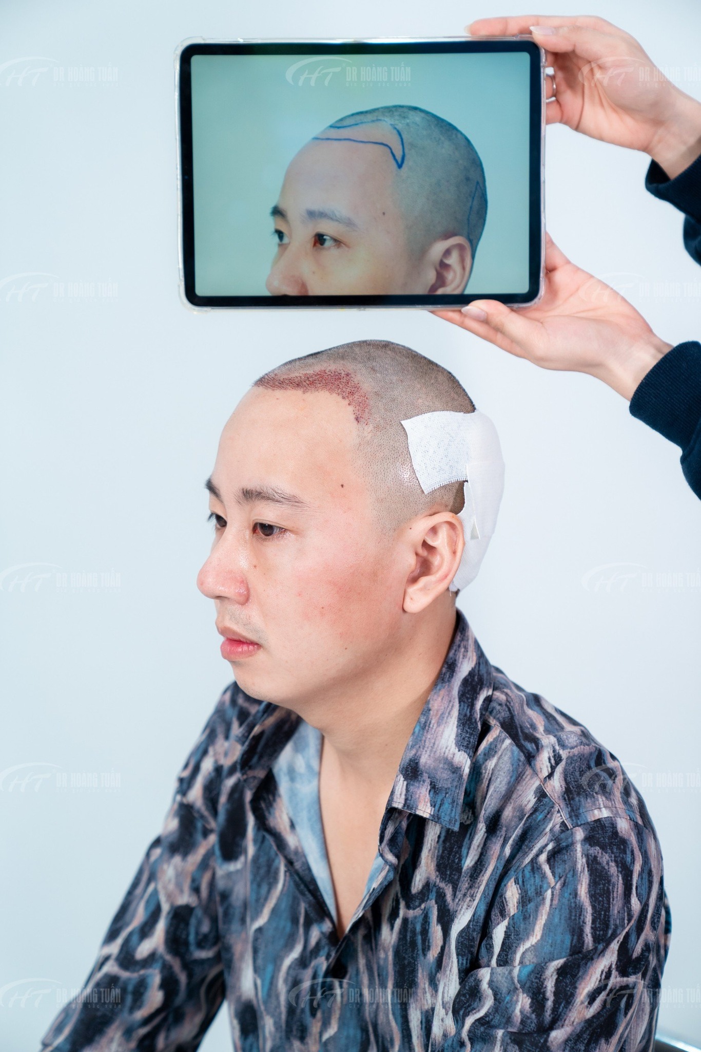 CẤY TÓC NAM GIÁ BAO NHIÊU|PHÒNG KHÁM ĐA KHOA HOÀNG TUẤN HÀ ĐÔNG