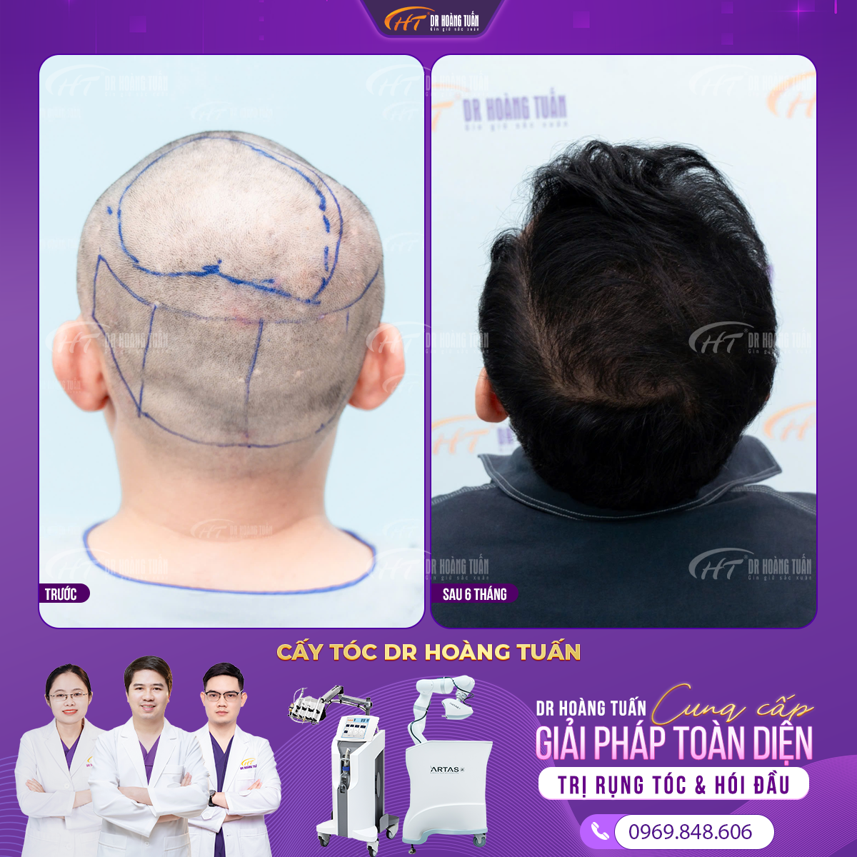 Cấy t&oacute;c b&aacute;n tự động NeoGraft