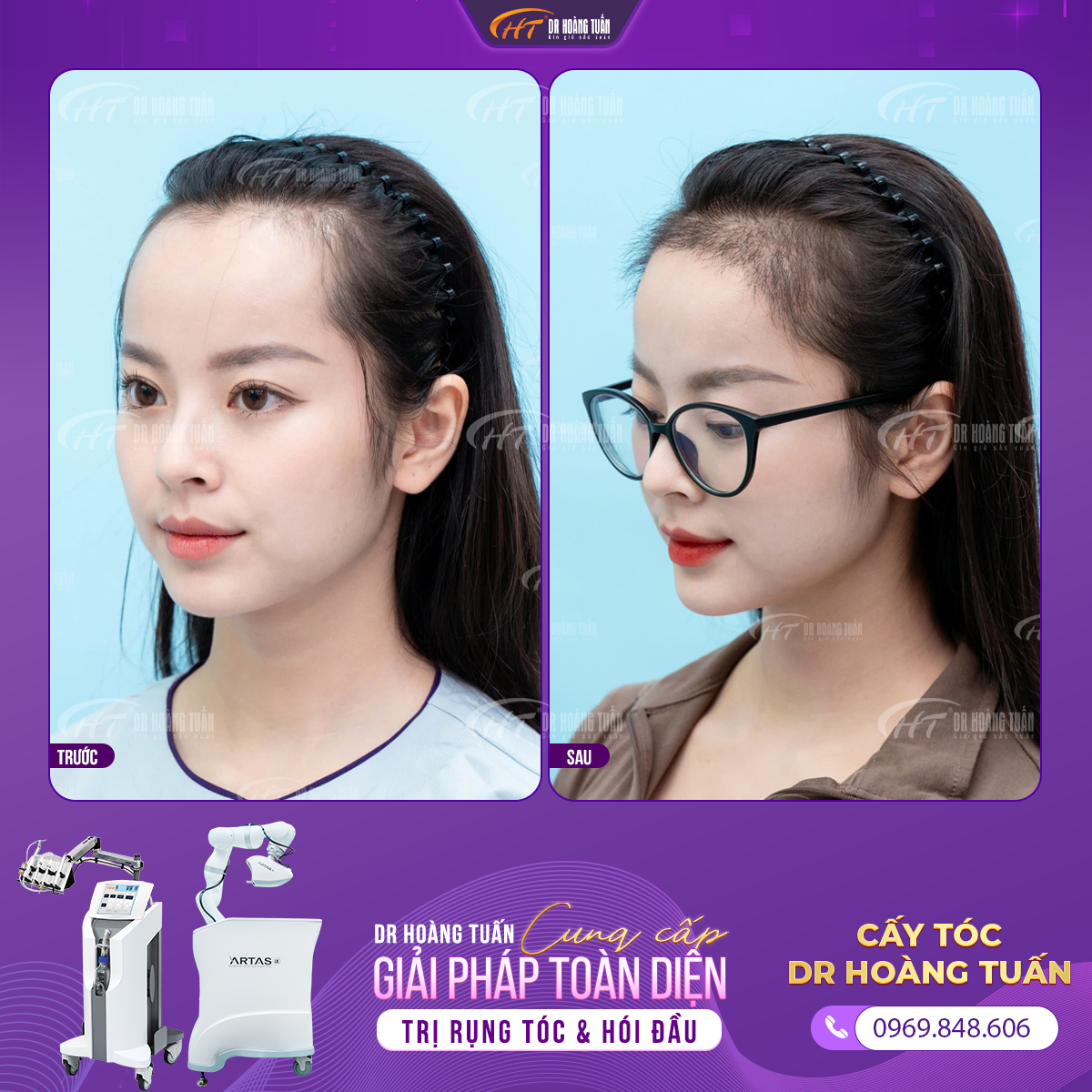 Cải thiện đường ch&acirc;n t&oacute;c