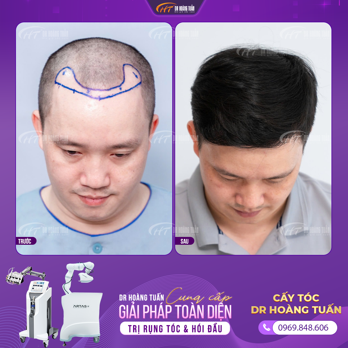 Dịch vụ cấy t&oacute;c tại Dr Ho&agrave;ng Tuấn