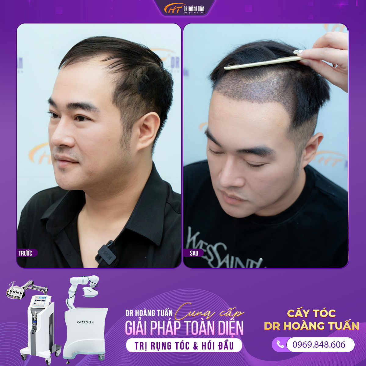  yếu tố ảnh hưởng đến cấy t&oacute;c