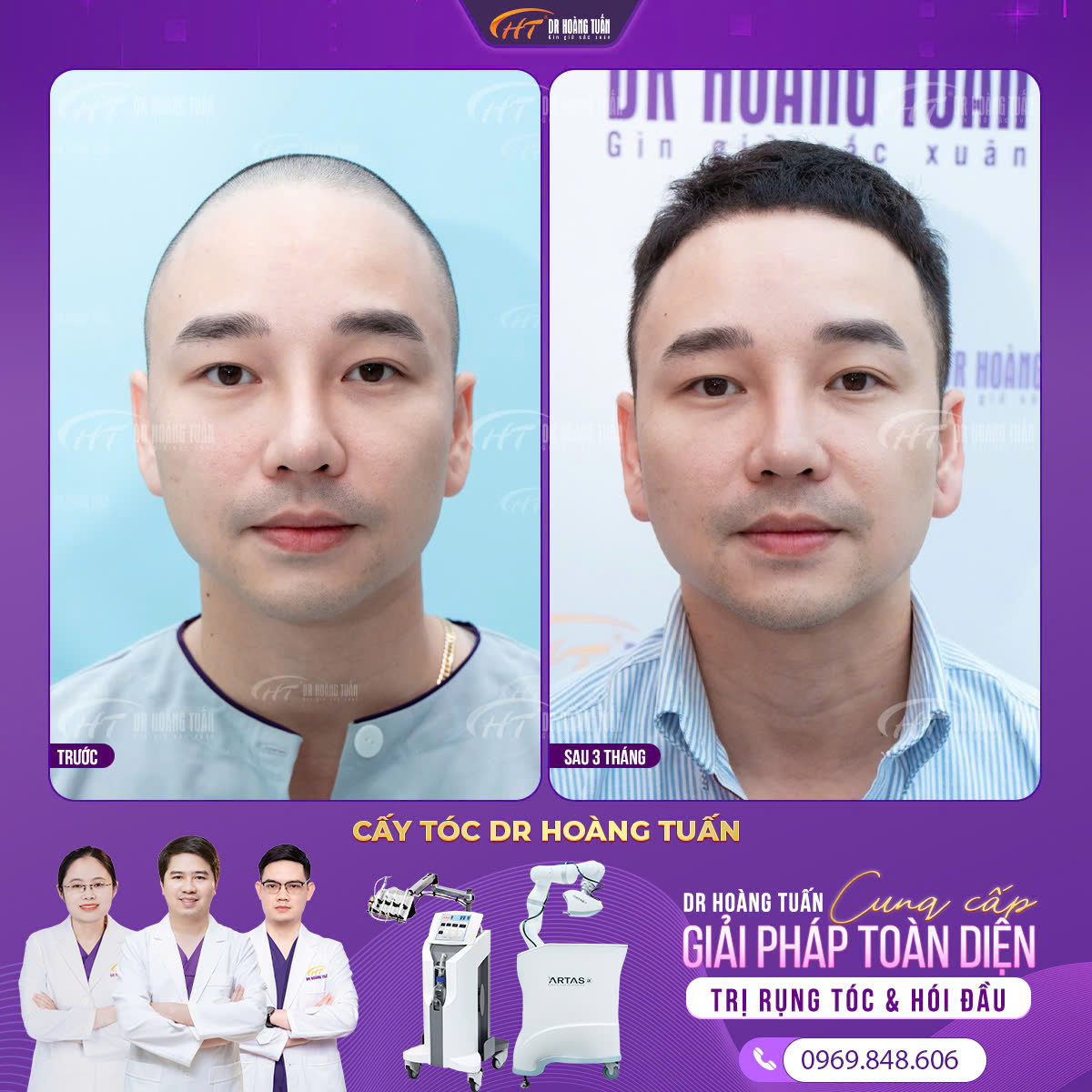 Chăm s&oacute;c da đầu sau cấy t&oacute;c