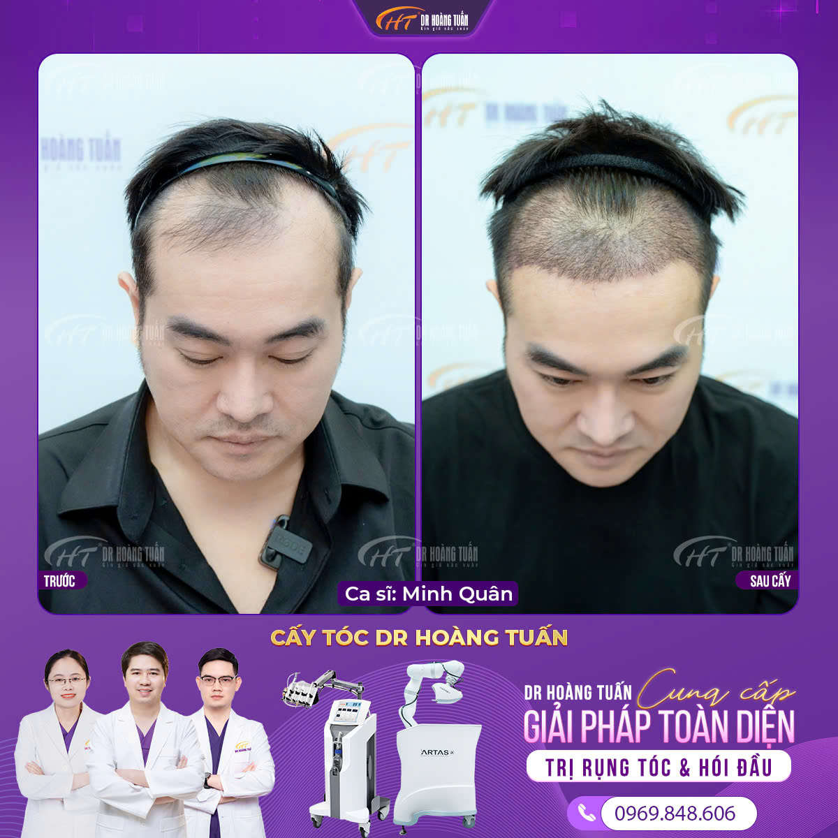 xu hướng cấy t&oacute;c năm 2025