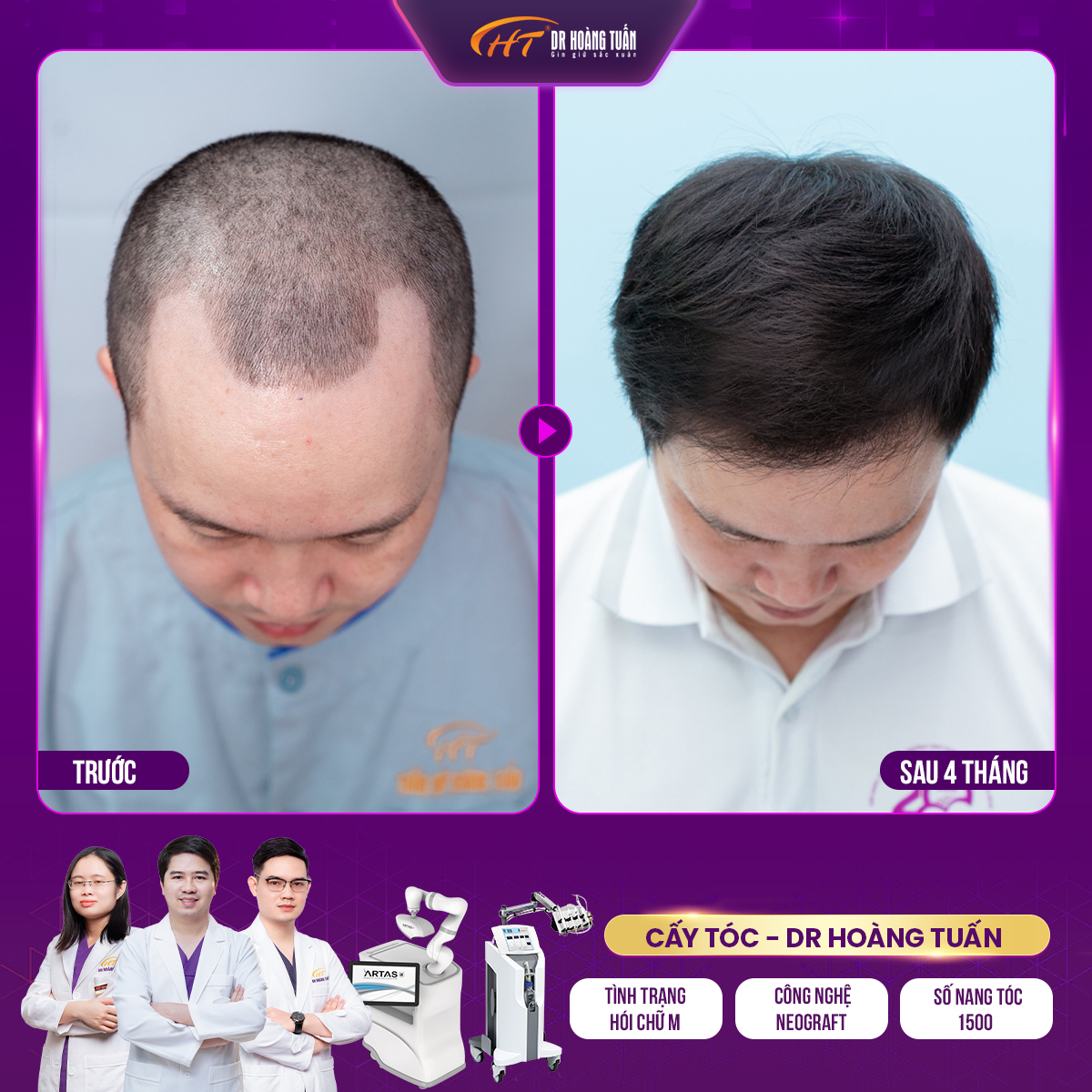 Cải thiện đường ch&acirc;n t&oacute;c