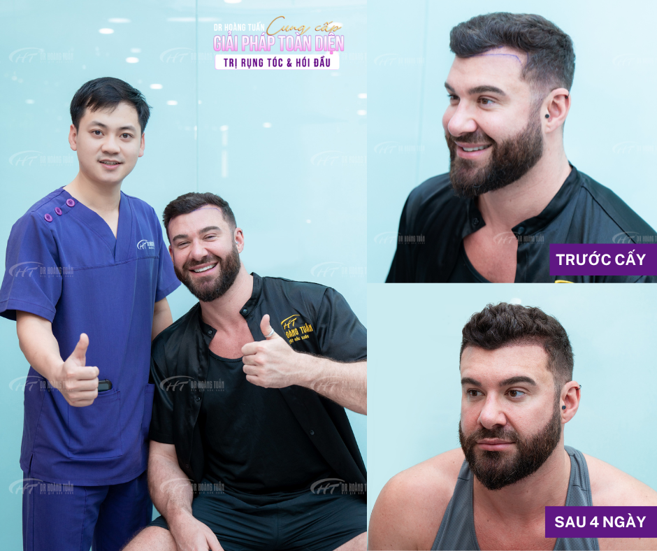 Chi ph&iacute; cấy t&oacute;c