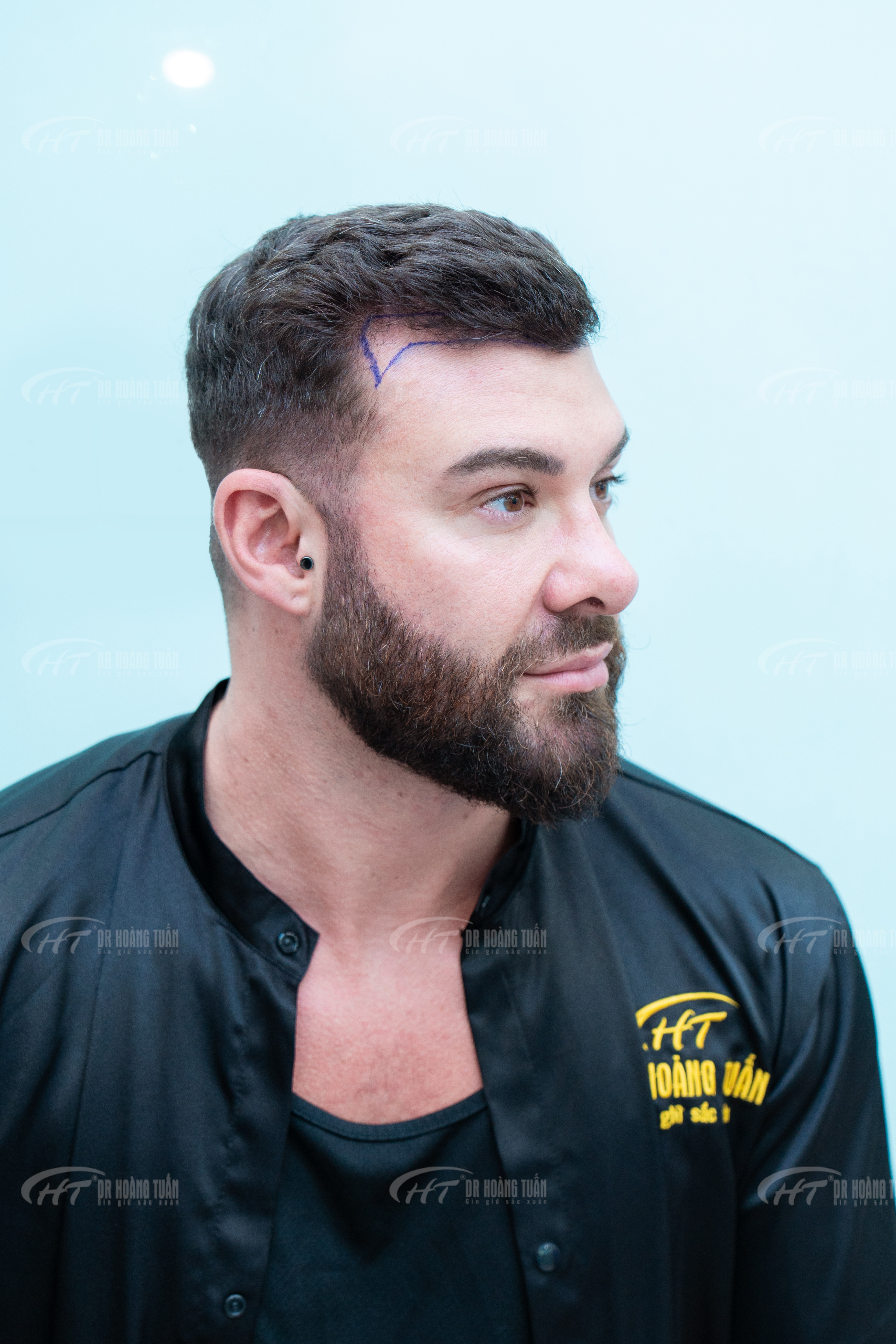 Cấy t&oacute;c tại Việt Nam