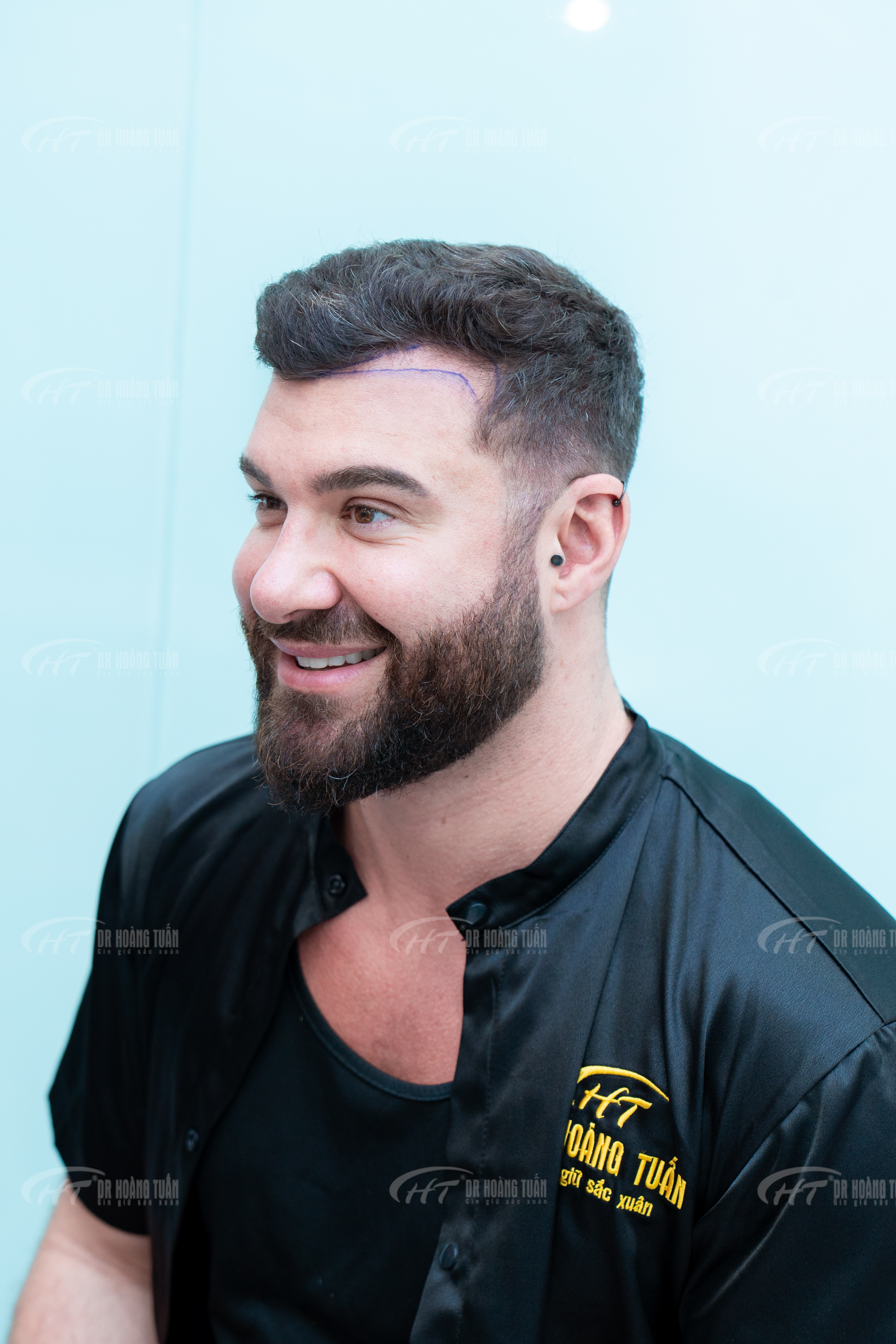 Cấy t&oacute;c tại Việt Nam