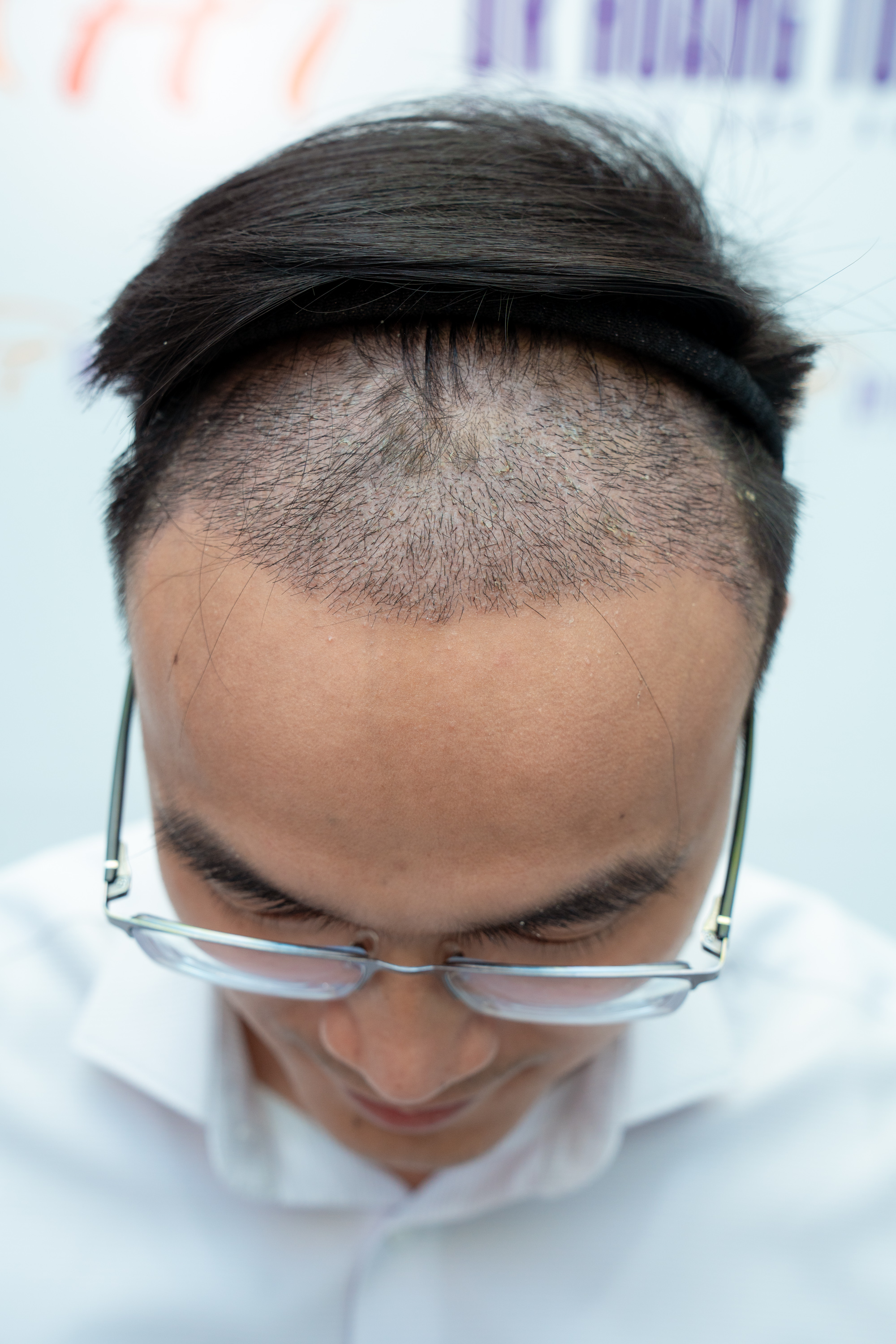 Chuẩn Bị Trước Khi Quyết Định Cấy T&oacute;c