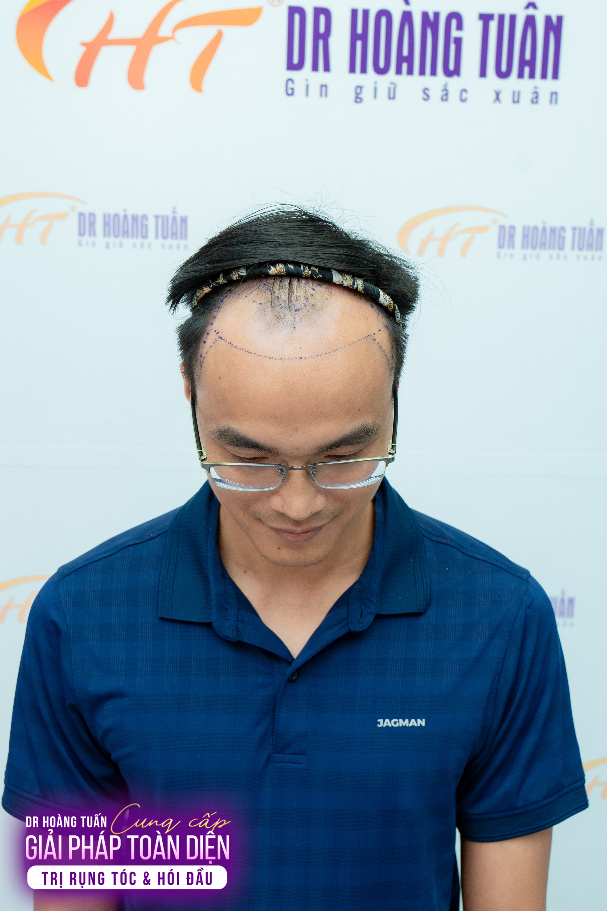 Chuẩn Bị Trước Khi Quyết Định Cấy T&oacute;c