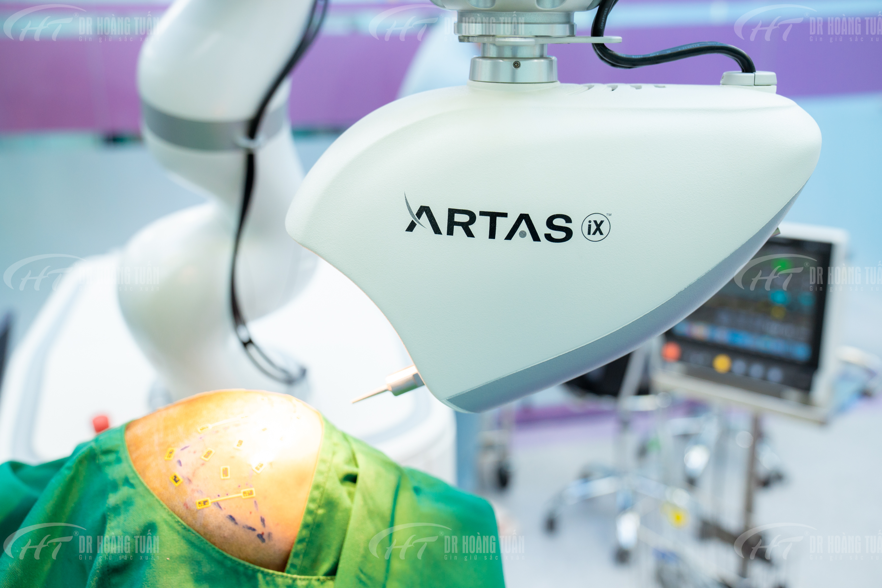 chi ph&iacute; cấy t&oacute;c