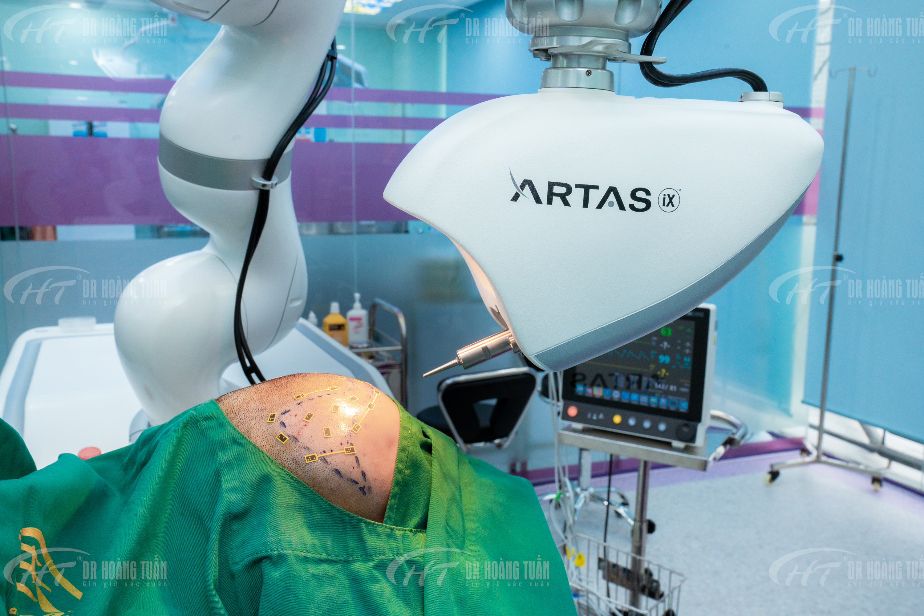 Ths. Bs Nguyễn Diệu Linh tham gia b&aacute;o c&aacute;o tại Hội nghị Quốc tế Thẩm mỹ Quốc tế lớn nhất to&agrave;n cầu DASIL 2024 - Robot cấy t&oacute;c tự động ARTAS&reg; iX.