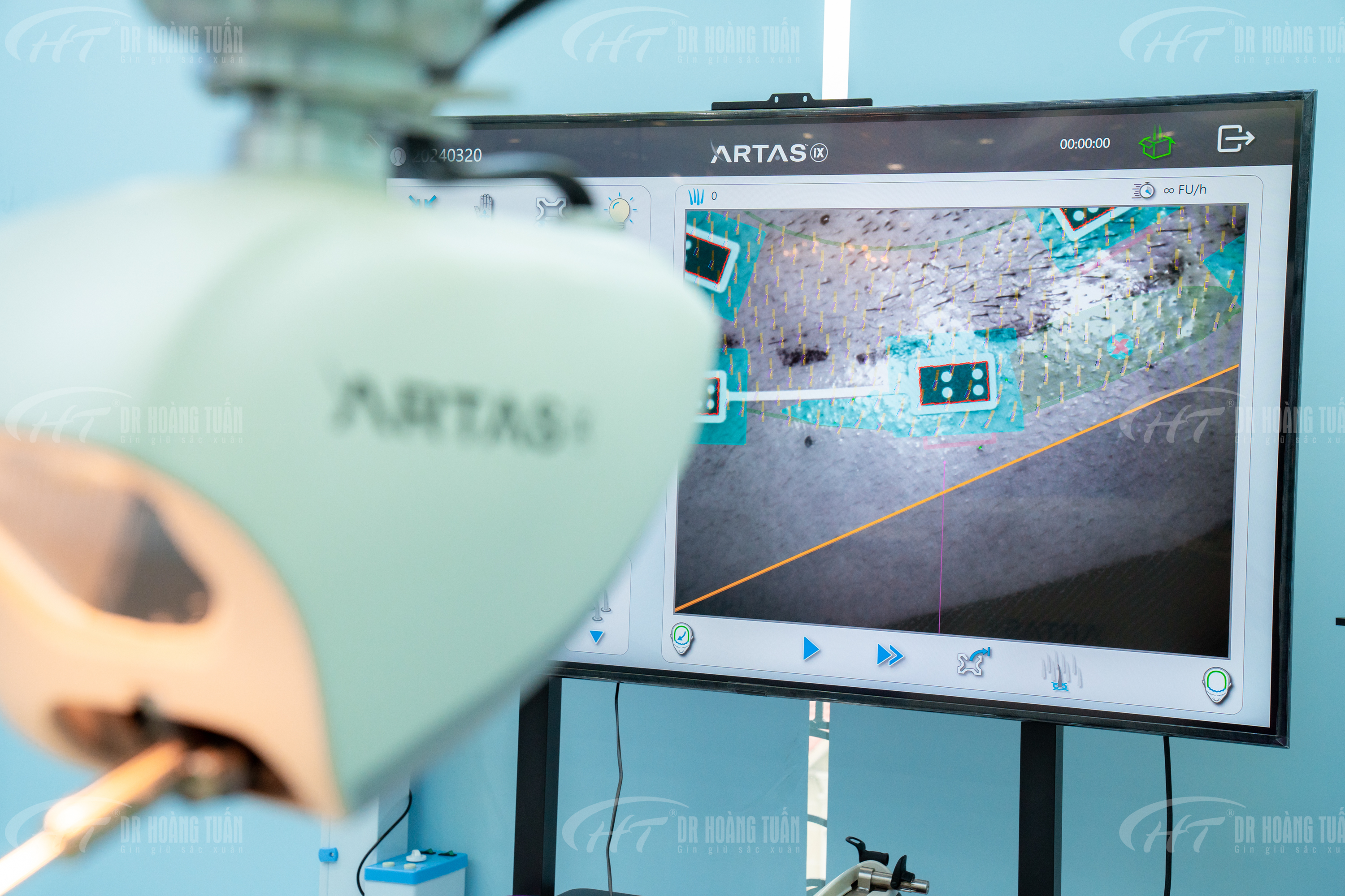 Ths. Bs Nguyễn Diệu Linh tham gia b&aacute;o c&aacute;o tại Hội nghị Quốc tế Thẩm mỹ Quốc tế lớn nhất to&agrave;n cầu DASIL 2024 - Robot cấy t&oacute;c tự động ARTAS&reg; iX.