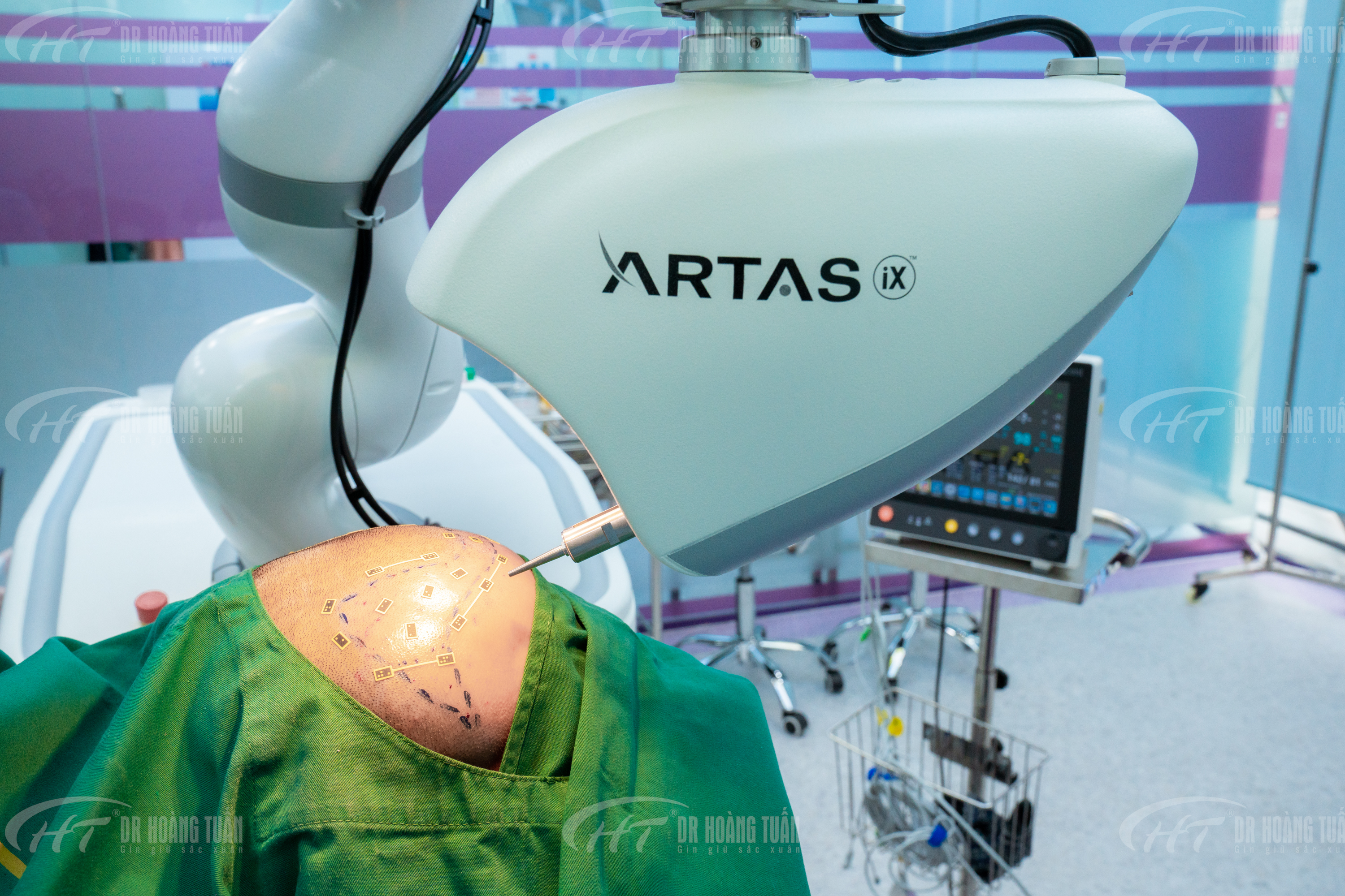 H&igrave;nh ảnh bộ đ&ocirc;i si&ecirc;u c&ocirc;ng nghệ hiện đại cấy t&oacute;c tại Dr Ho&agrave;ng Tuấn