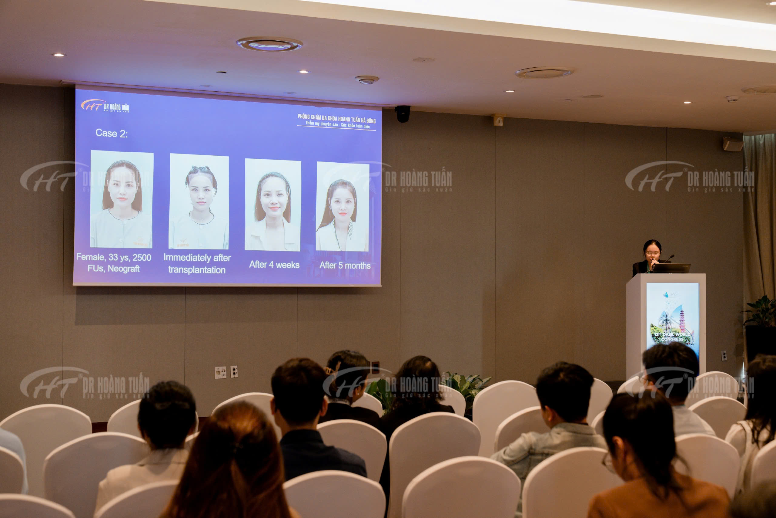 Ths. Bs Nguyễn Diệu Linh tham gia b&aacute;o c&aacute;o tại Hội nghị Quốc tế Thẩm mỹ Quốc tế lớn nhất to&agrave;n cầu DASIL 2024 - Robot cấy t&oacute;c tự động ARTAS&reg; iX.