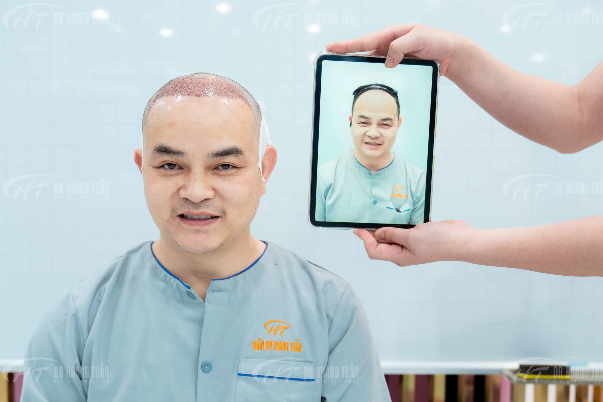 Cấy t&oacute;c FUE v&agrave; FUT