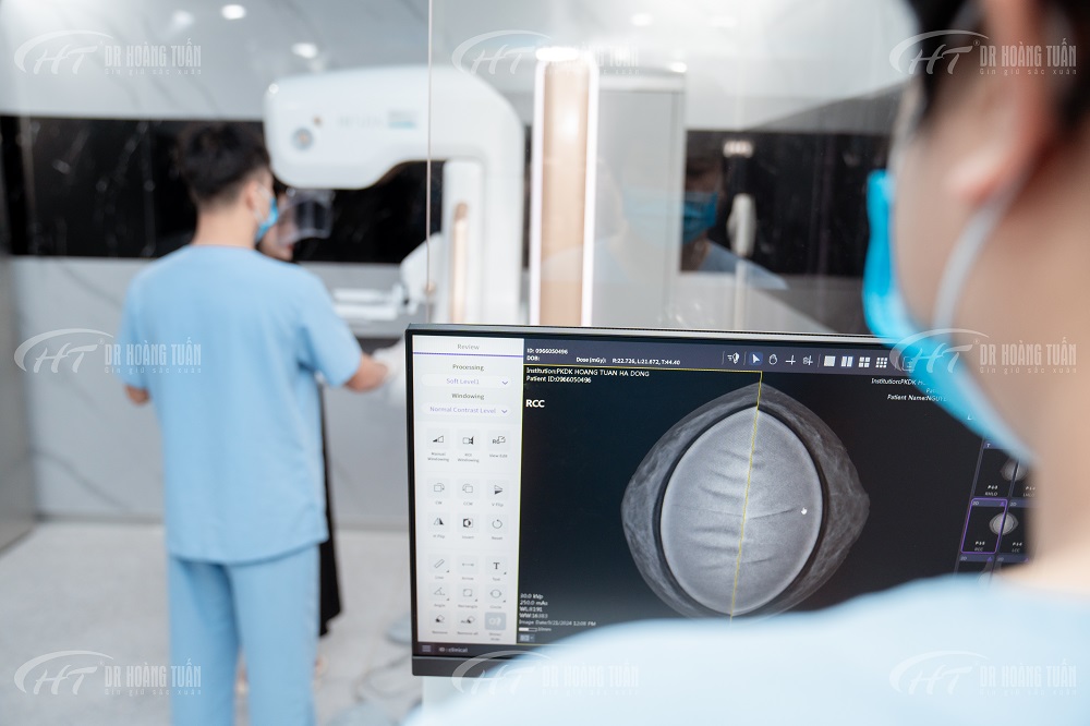 TẦM SOÁT UNG THƯ VÚ SAU NÂNG NGỰC