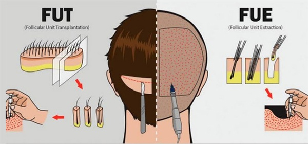 Cấy t&oacute;c FUE v&agrave; FUT