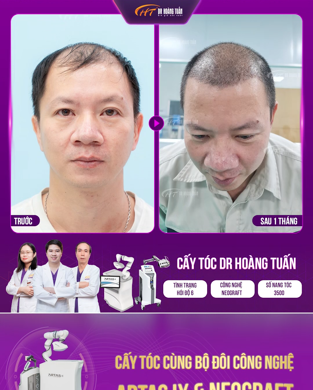 Cấy tóc bán tự động<br> Neograft