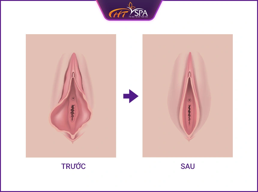 h&igrave;nh ảnh trước v&agrave; sau th&acirc;m mỹ v&ugrave;ng k&iacute;n 