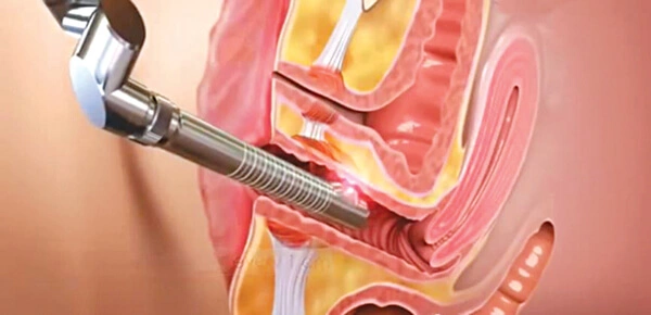 C&ocirc;ng nghệ trẻ h&oacute;a &acirc;m đạo bằng laser gi&uacute;p se k, l&agrave;m đẹp v&ugrave;ng k&iacute;n