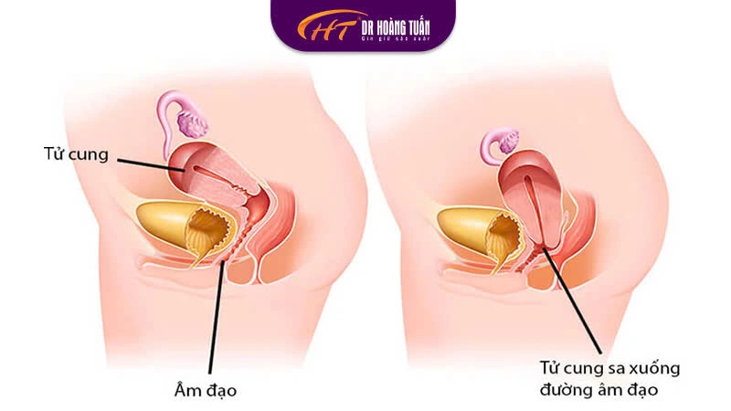 H&igrave;nh ảnh m&ocirc; phỏng t&igrave;nh trạng sa tử cung v&agrave; cấu tr&uacute;c cơ quan sinh dục nữ, V&ugrave;ng k&iacute;n xuống cấp