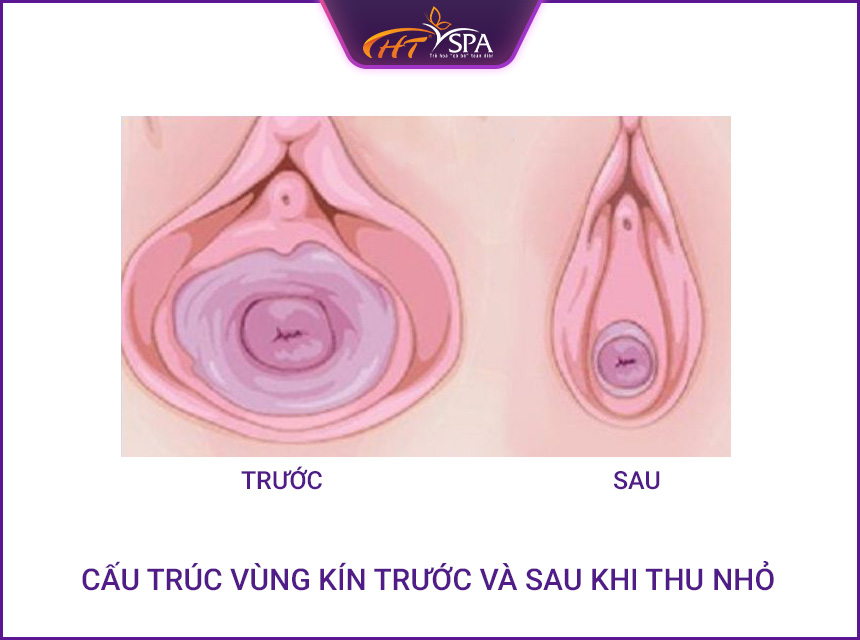 ảnh v&ugrave;ng k&iacute;n xuống cấp 