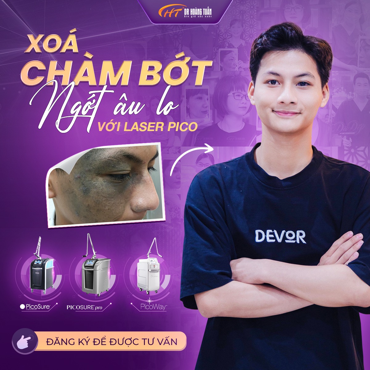 Trị bớt sắc tố