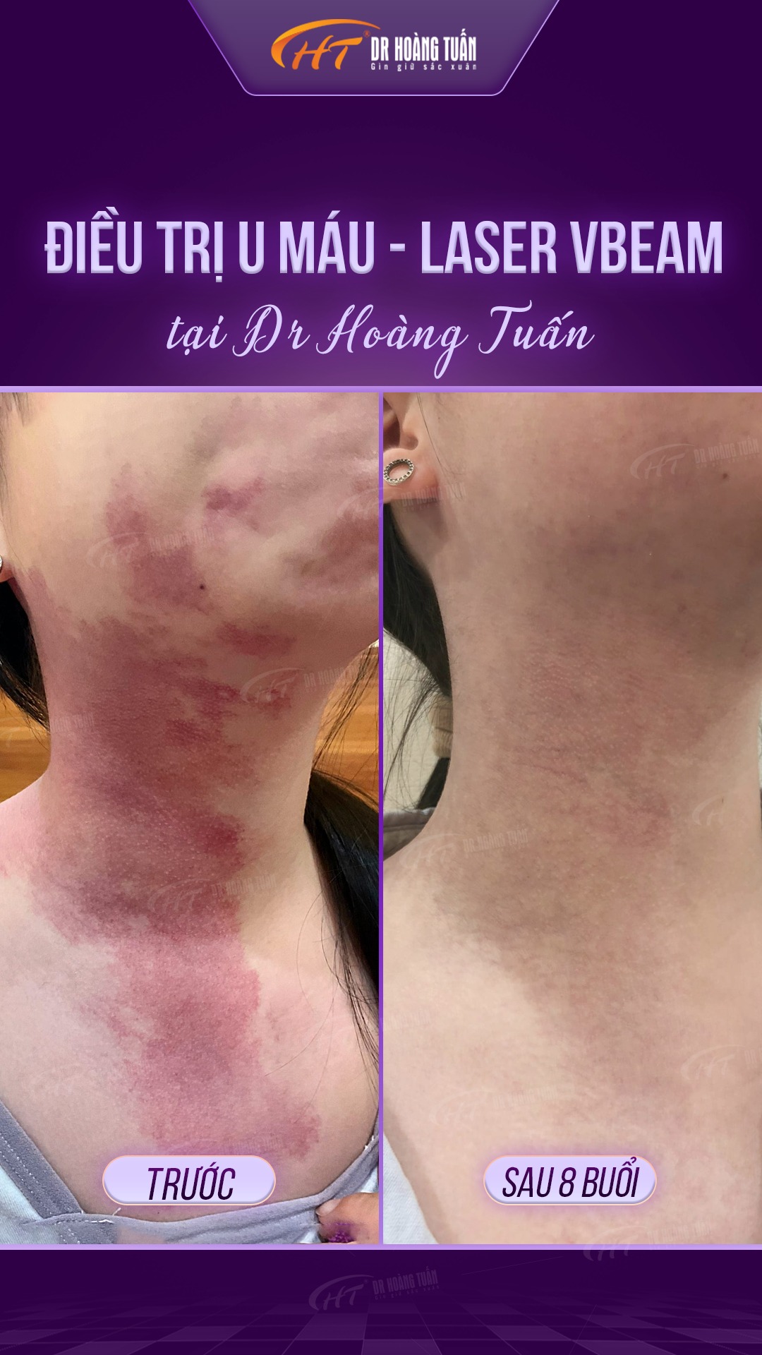 Trị u máu - bớt máu