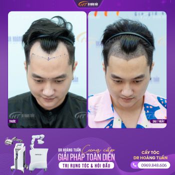 [KENH14.VN] DIỄN VIÊN “PHỐ TRONG LÀNG” ĐI CẤY TÓC: NGỦ MỘT GIẤC TỈNH DẬY, TRÁN HÓI CHỮ M “BAY MÀU”, TRẺ RA VÀI TUỔI